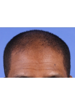 Before Hair Transplant&nbsp;Front